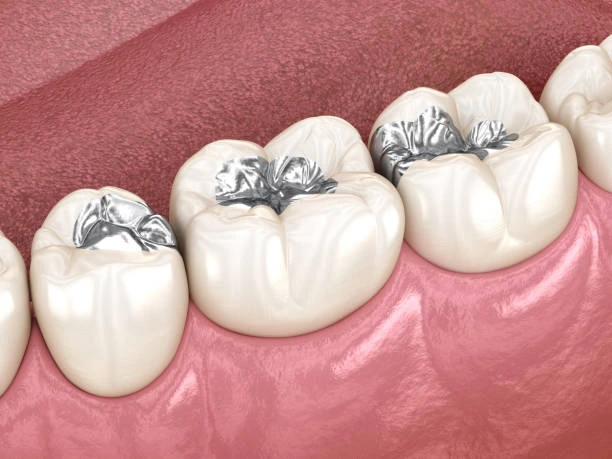 Signs Your Silver Fillings Need Replacement: South Baltimore Guide