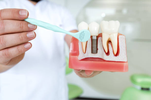 Dental Implants vs. Dentures in South Baltimore: Which Is the Better Long-Term Value?