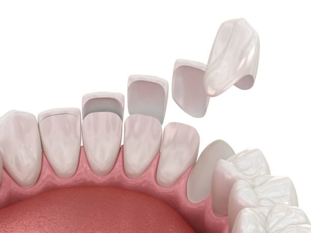 Problems with Veneers: What South Baltimore Patients Should Watch Out For