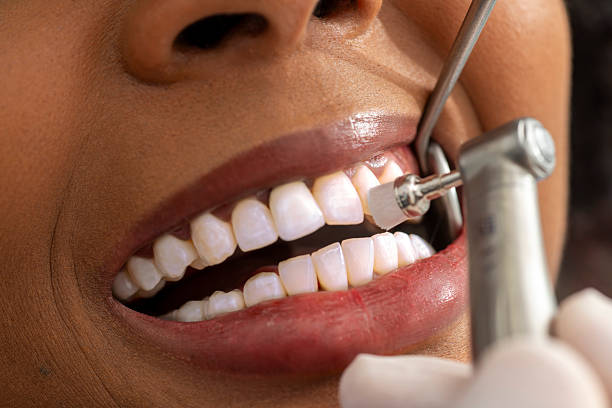 How Often Should You Get a Dental Cleaning in South Baltimore?
