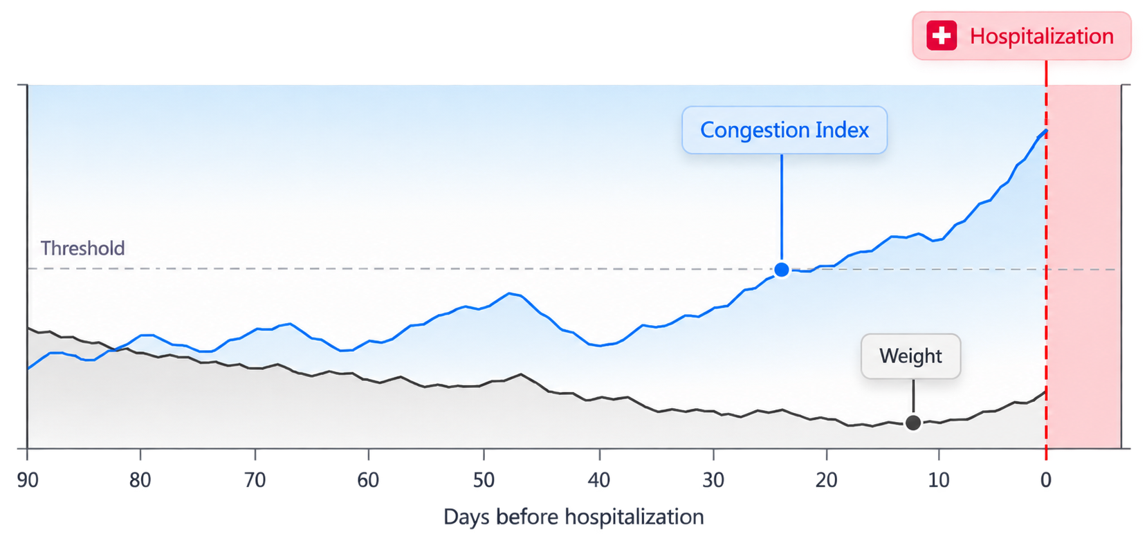 Illustrative example of Congestion Index rising before a heart failure hospitalization while weight stays comparatively low