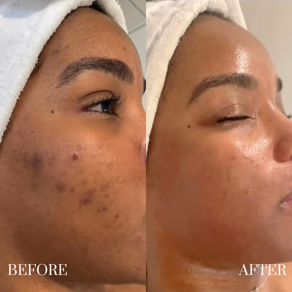 Side-by-side close-up of a woman's face showing acne before and clear skin after treatment.
