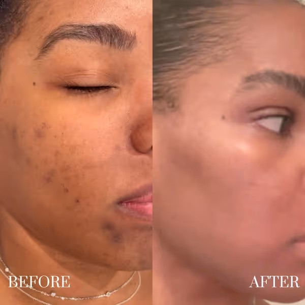 Side-by-side close-up of woman's face showing skin before and after treatment with reduced dark spots.