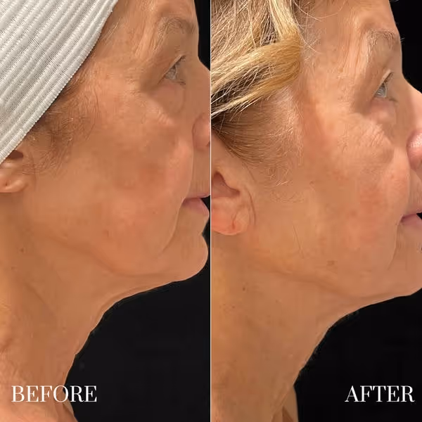Side-by-side photos showing a woman's face and neck before and after microneedling treatment.