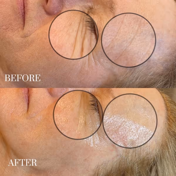 Before and after close-up of facial skin showing reduced fine lines and smoother texture around the eye.