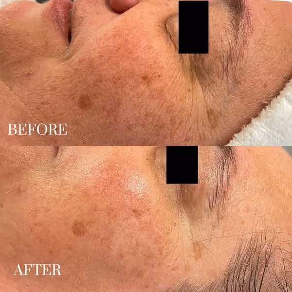Side-by-side before and after close-ups showing reduced redness and smoother skin on a person's cheek and eye area.