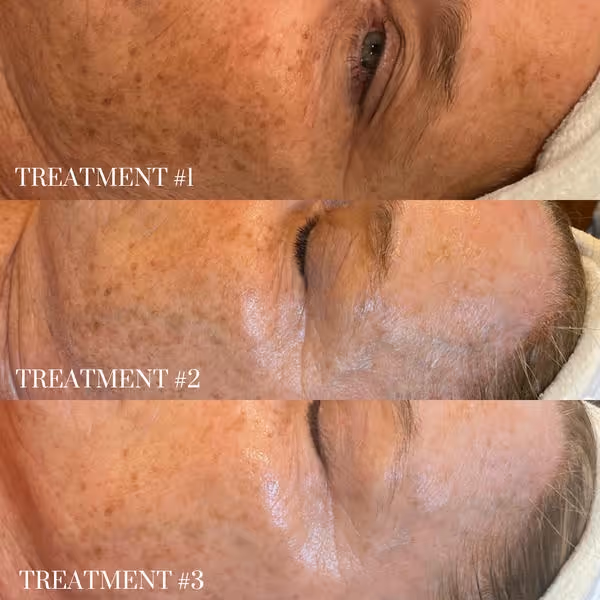 Three close-up face photos showing progressive fading of age spots from treatment one to three.