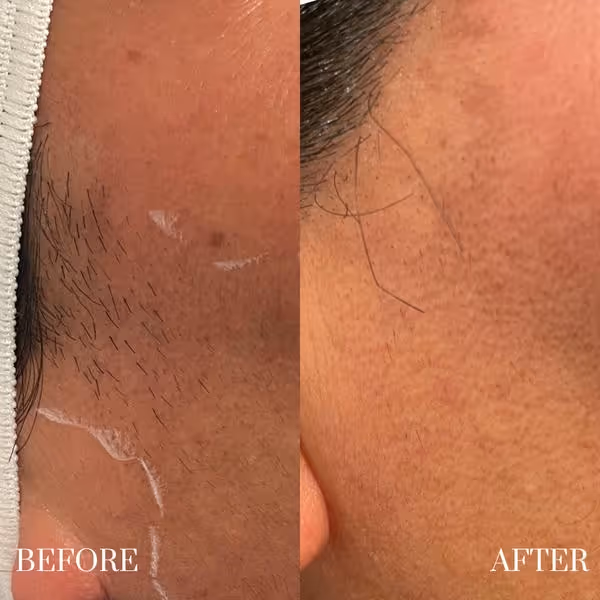 Side-by-side close-up showing facial hair before and after laser hair removal treatment.
