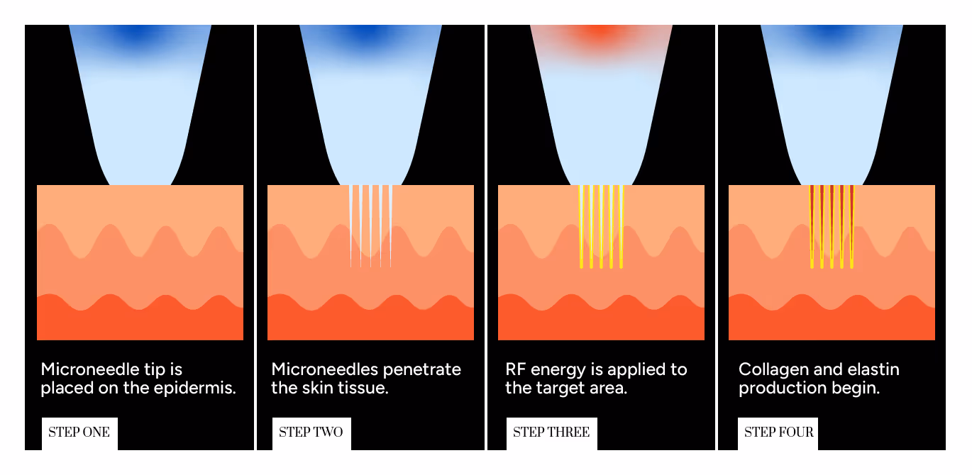 Step-by-step process of RF microneedling treatment"