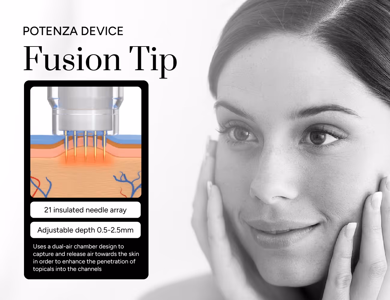 Fusion tip technology for effective RF microneedling treatment