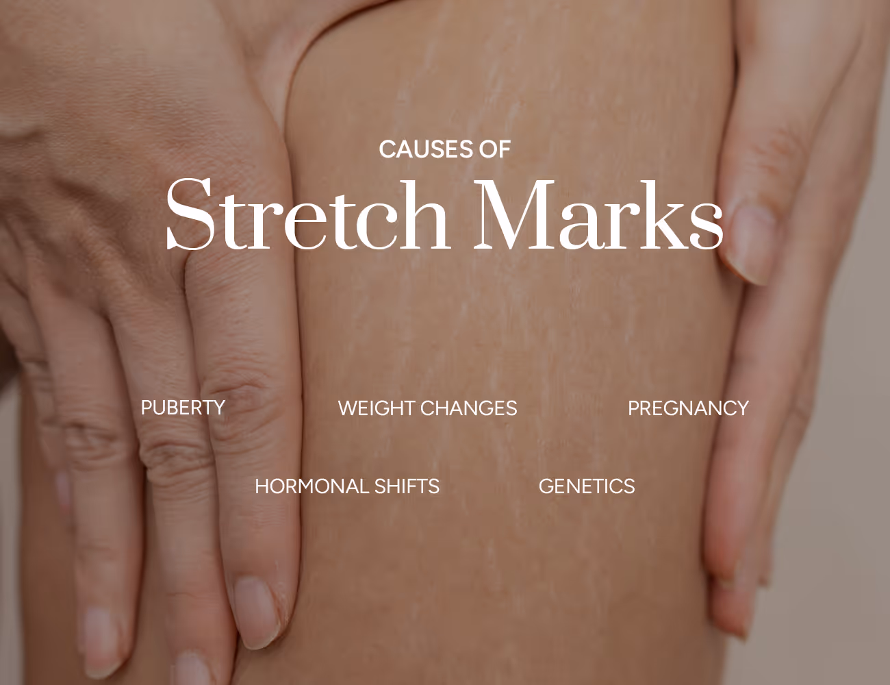 What are main causes of stretch marks