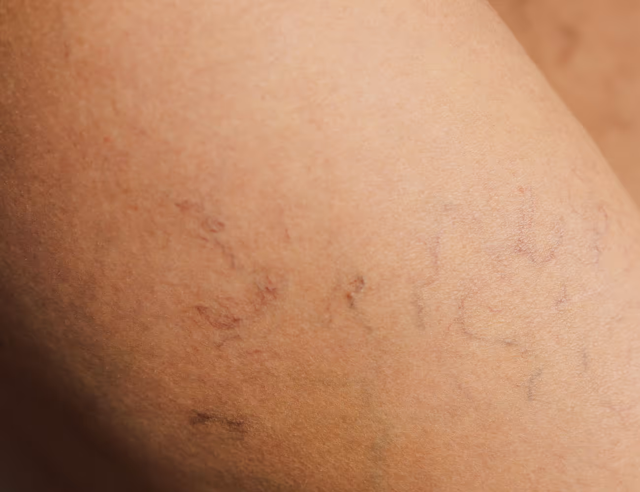 Spider Veins – Causes, Non-Invasive Treatments, and Prevention