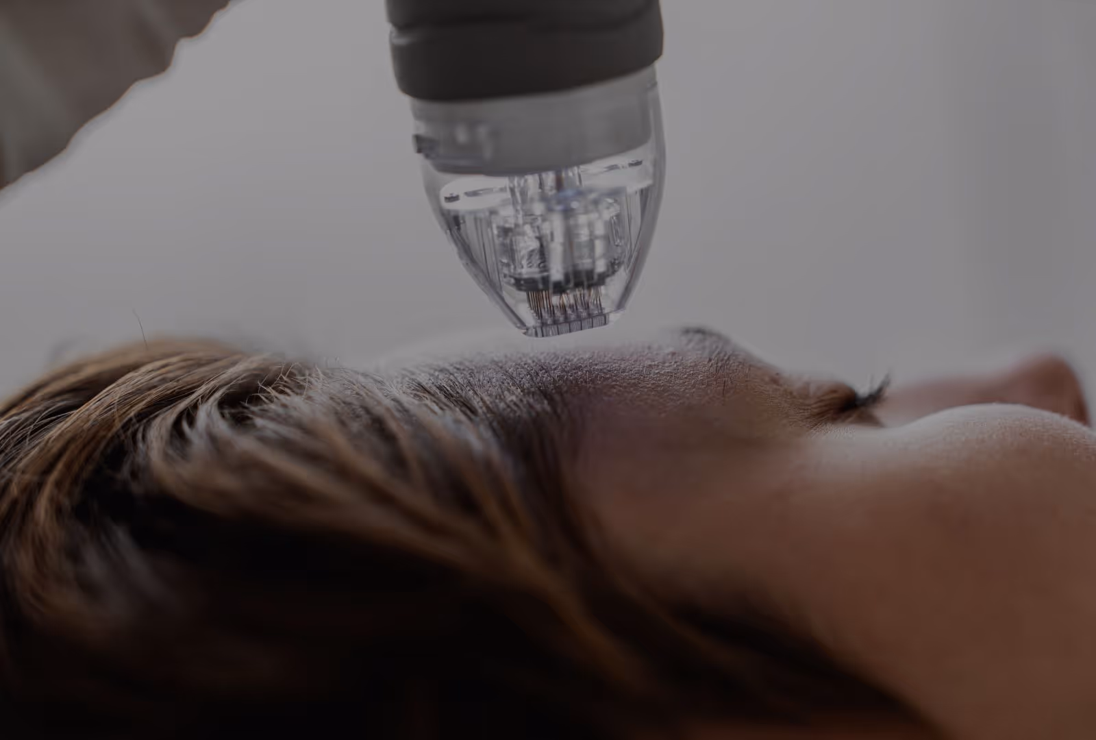 Does Microneedling Hurt?