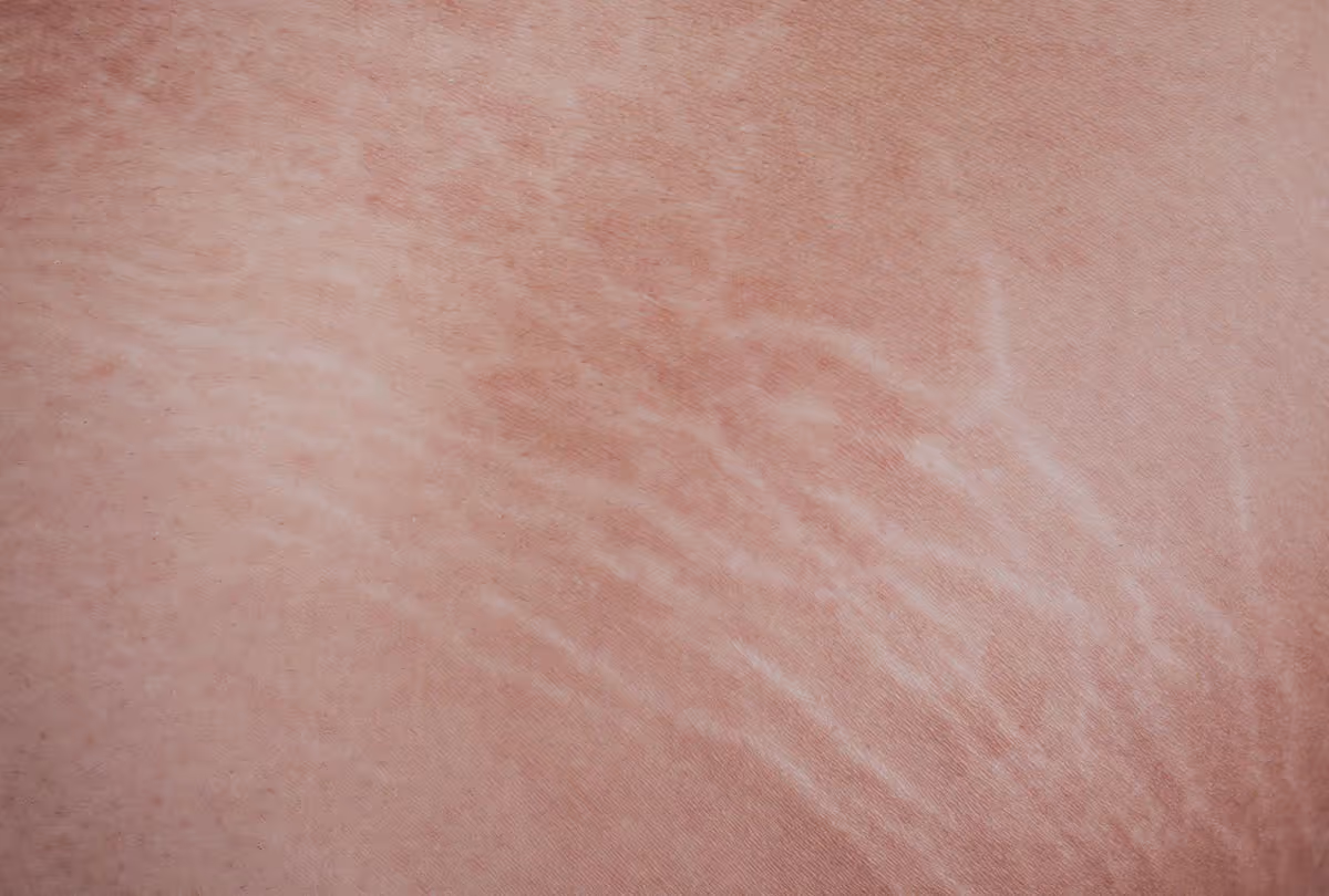 Can You Get Stretch Marks from Losing Weight?