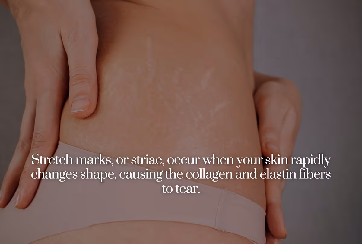 Stretch marks occur with weight gain