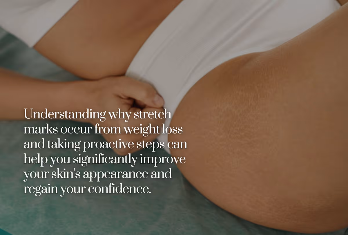 Stretch Marks Treatment