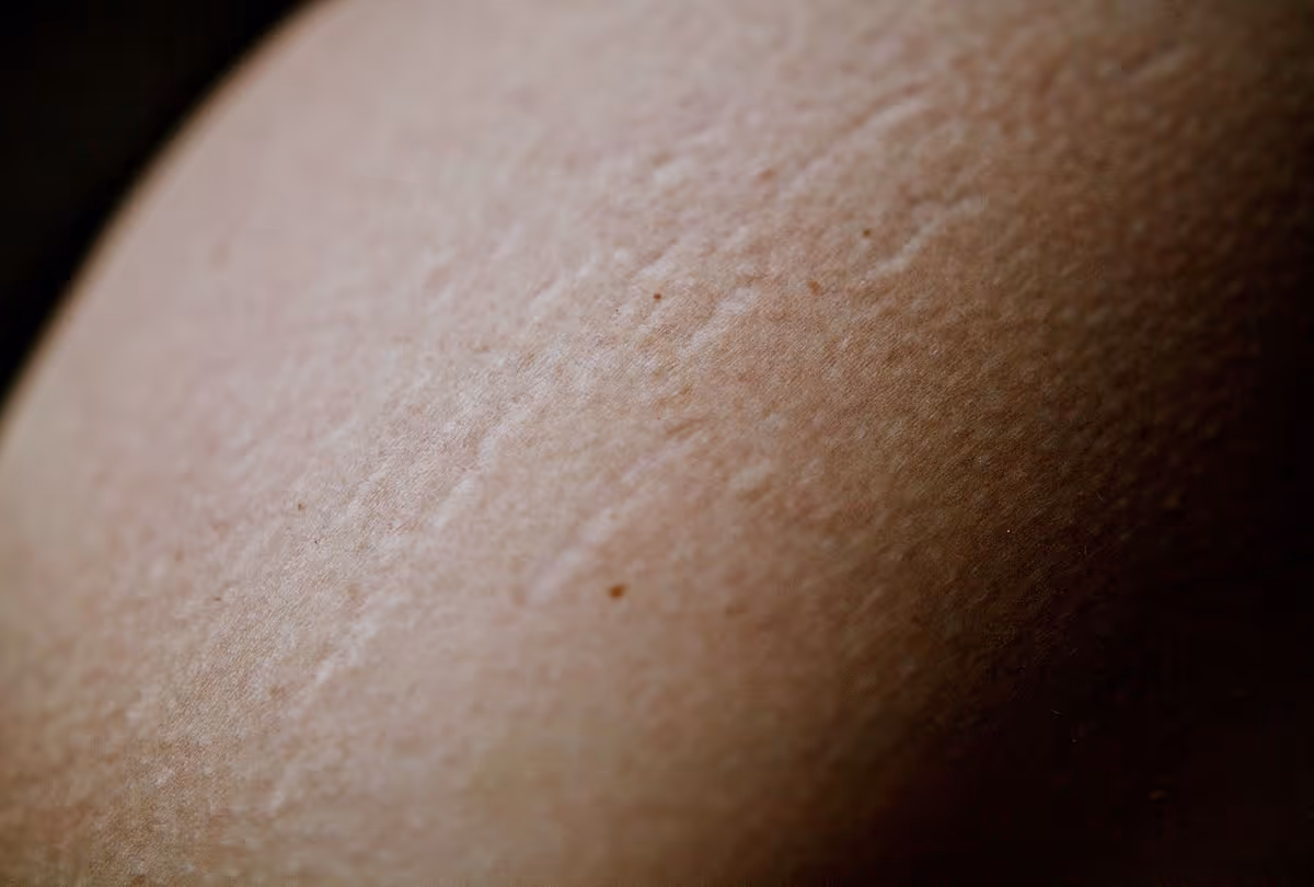 Can You Get Rid of Stretch marks from Losing Weight