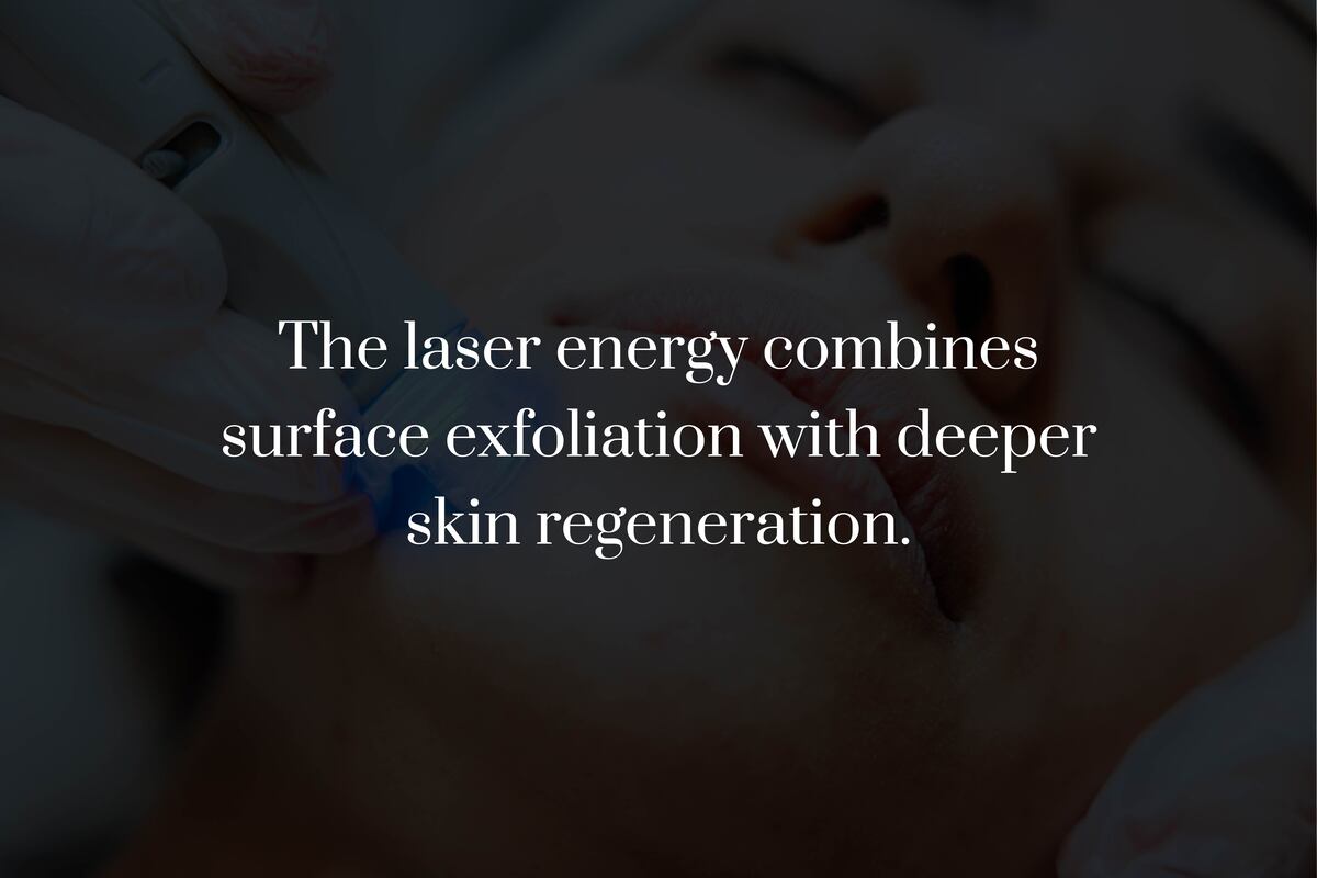 How Does Laser Skin Resurfacing Work?