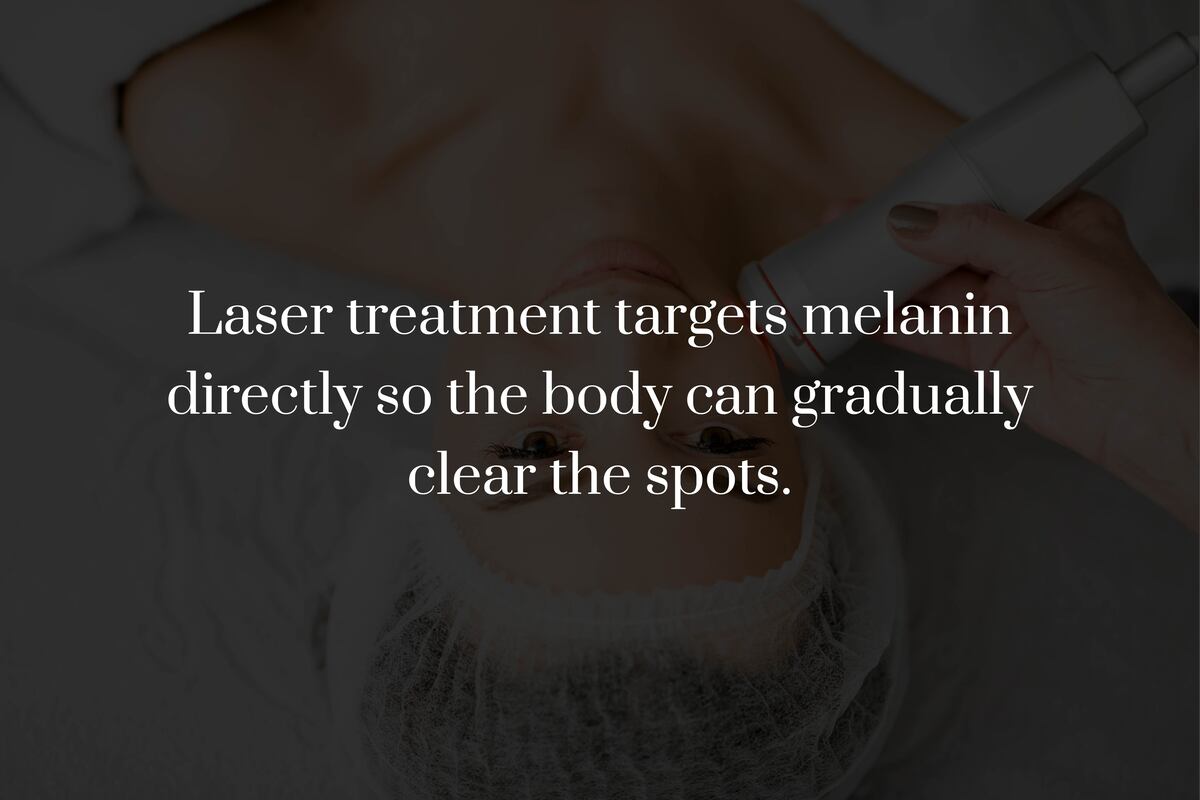How Does Laser Treatment Remove Age Spots?