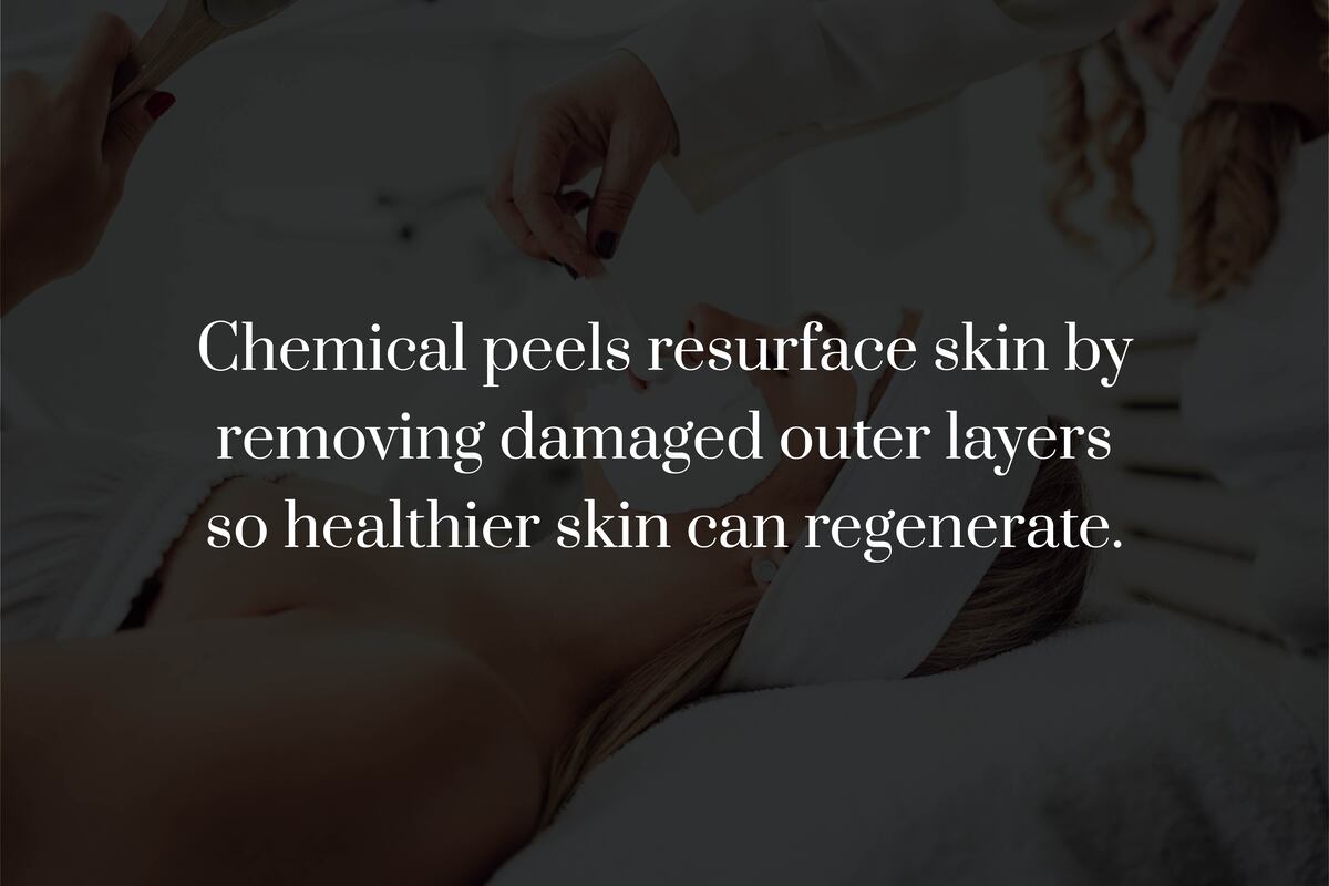 What Is a Chemical Peel?