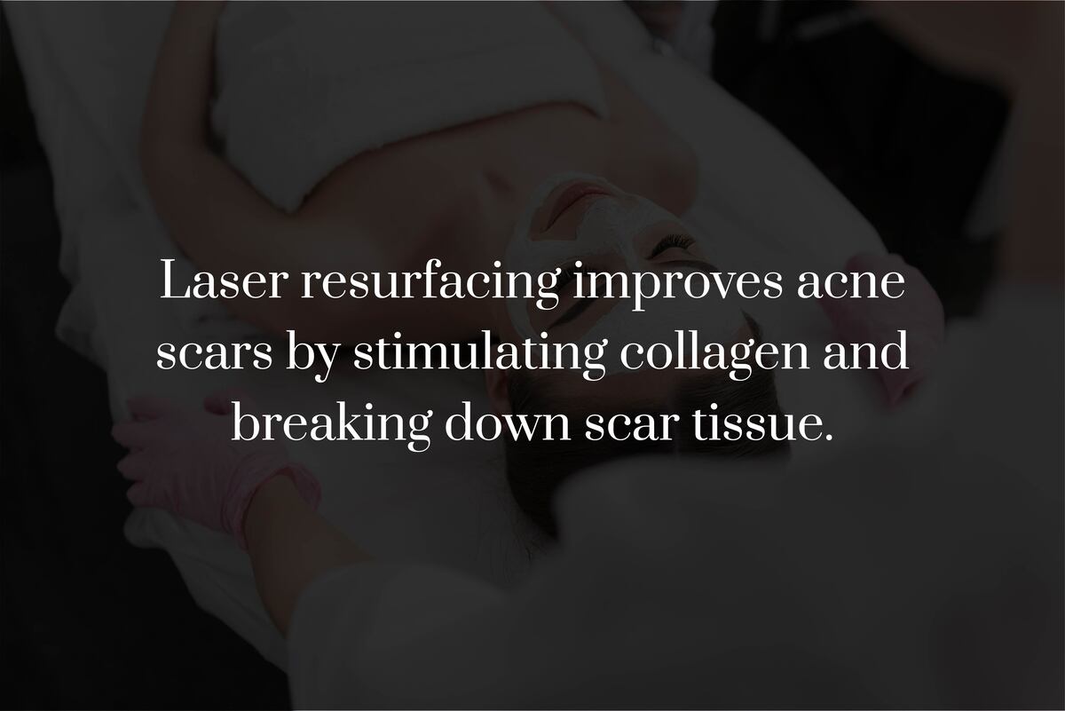 How Does Laser Resurfacing Treat Acne Scars?