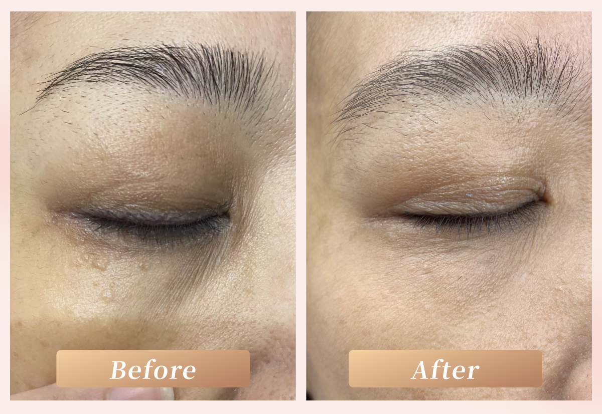 汗管瘤成功案例