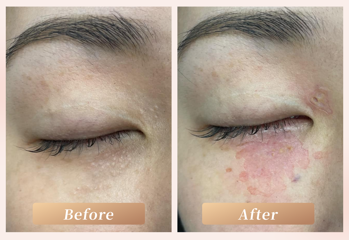 汗管瘤成功案例