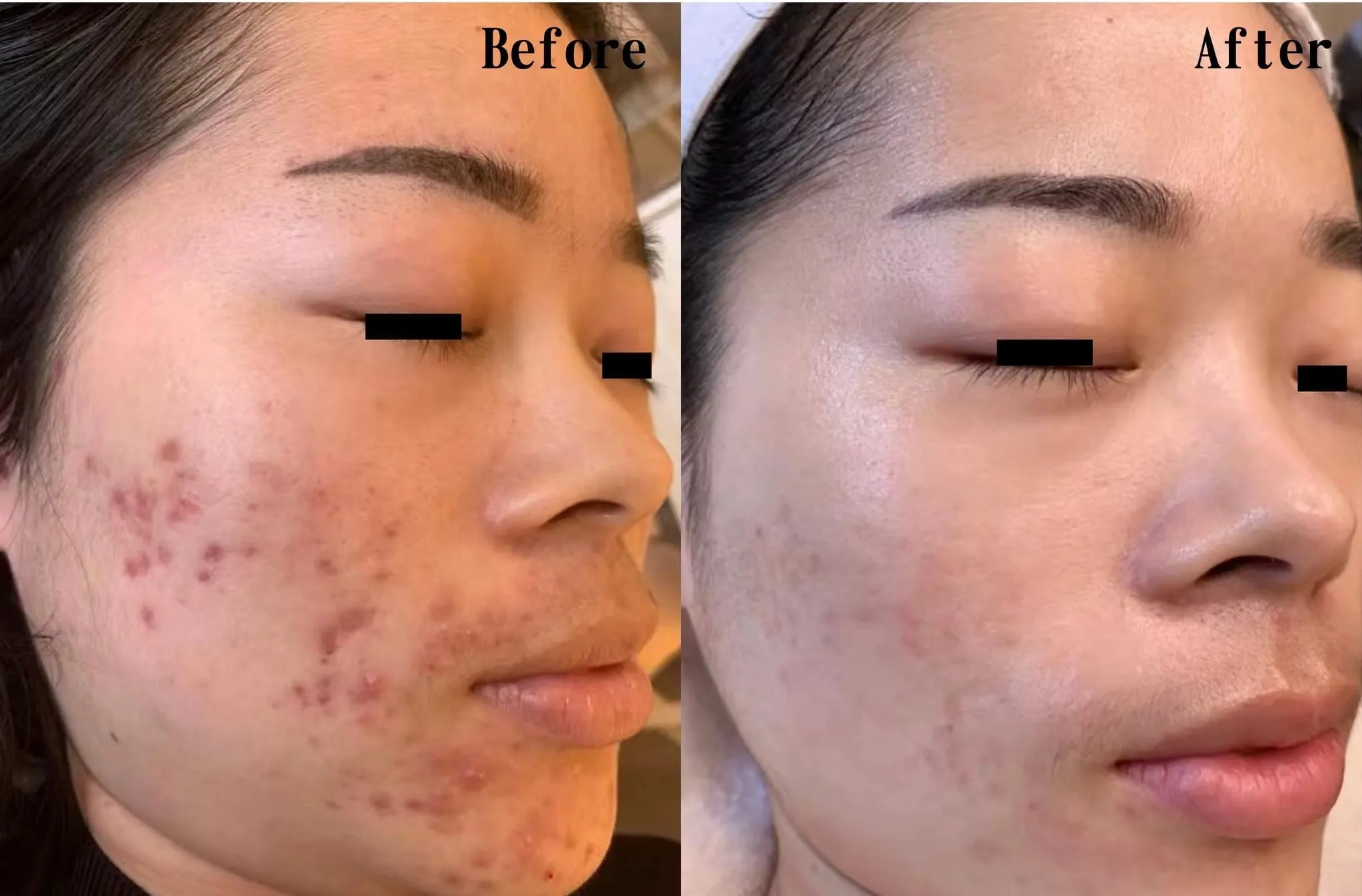 PicoSure Pro 鉑金蜂巢皮秒案例見證 — 美麗新城診所
