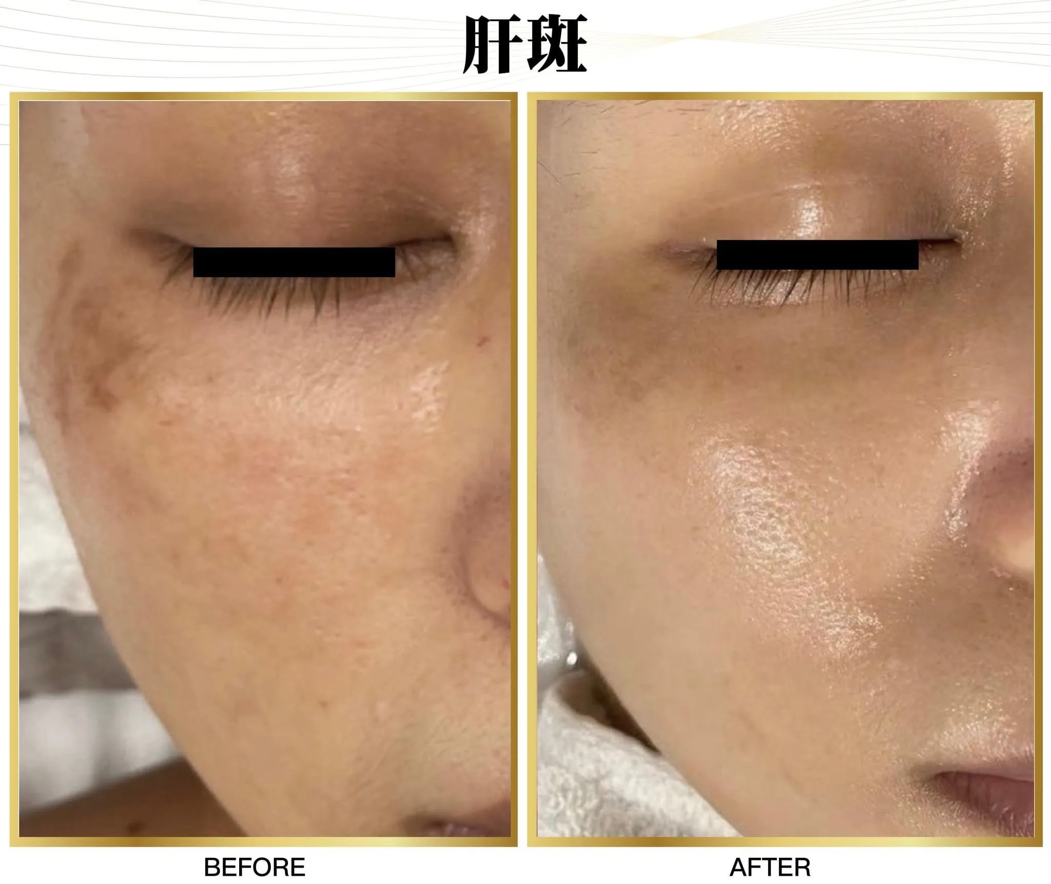 PicoSure Pro 鉑金蜂巢皮秒案例見證 — 美麗新城診所