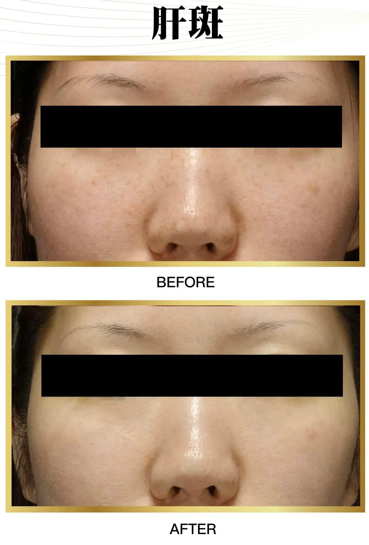 PicoSure Pro 鉑金蜂巢皮秒案例見證 — 美麗新城診所