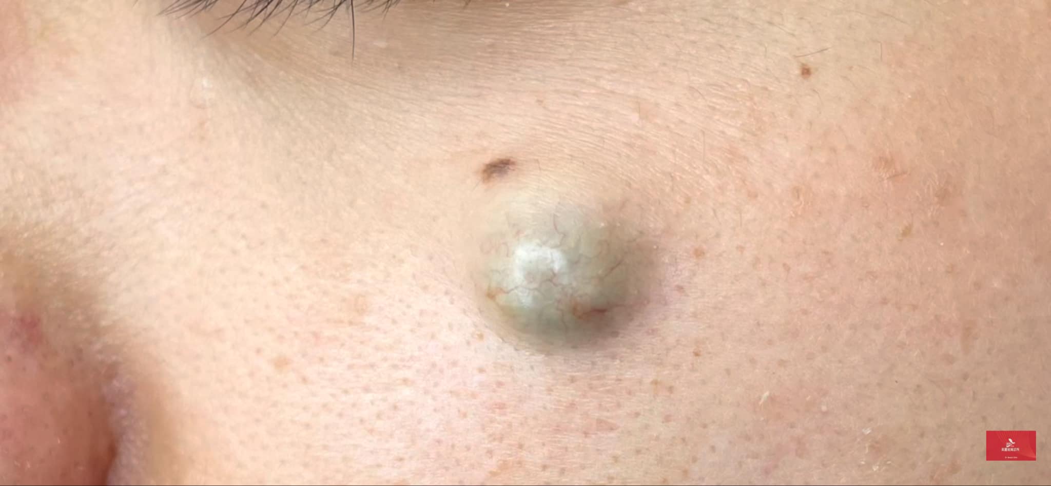 認識粉瘤:早期微創手術避免疤痕、纖維化與蟹足腫