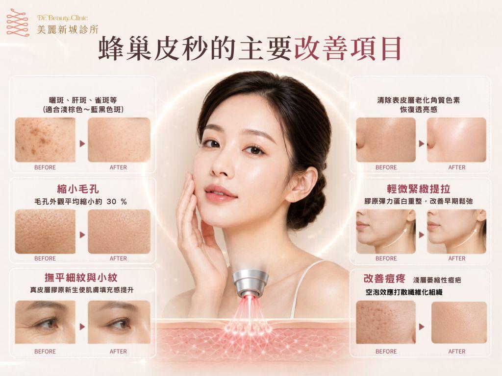 蜂巢皮秒毛孔與斑點改善效果