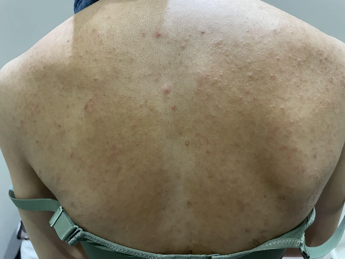 皮屑芽孢菌毛囊炎 別再誤認為青春痘!