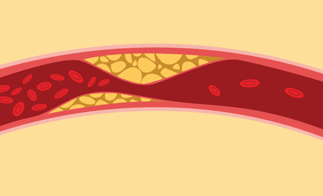 High cholesterol has no symptoms but can silently damage your arteries. Visit Cardiology Center Zacharias Kounnis in Limassol for expert prevention and treatment at one of the best cardiology centers in Cyprus.
