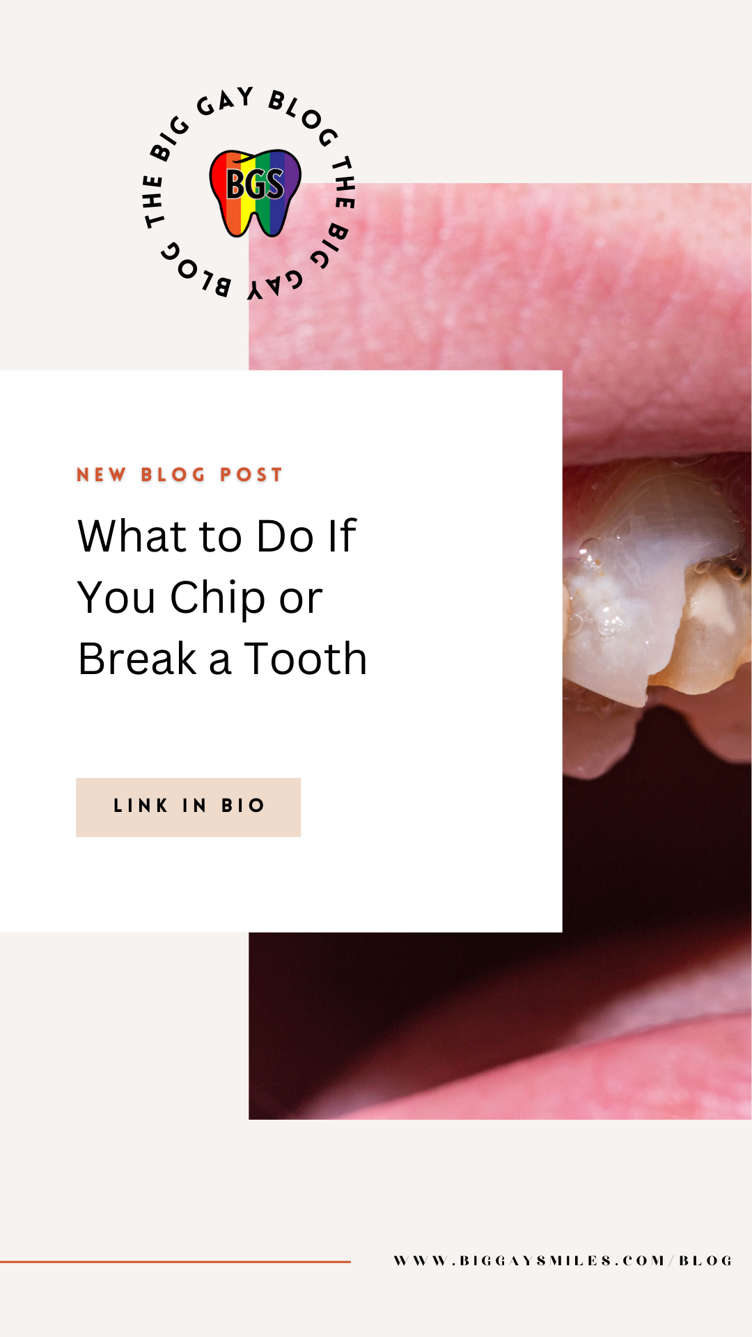 What to Do If You Chip or Break a Tooth
