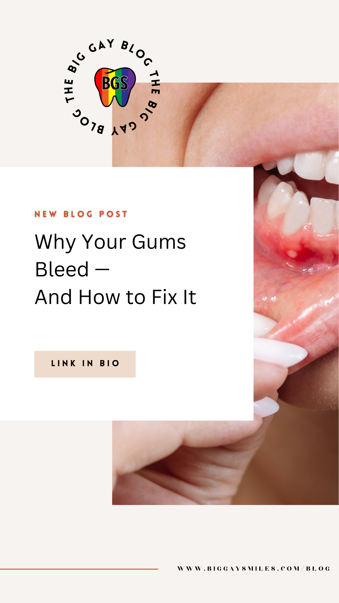 Why Your Gums Bleed — And How to Fix It