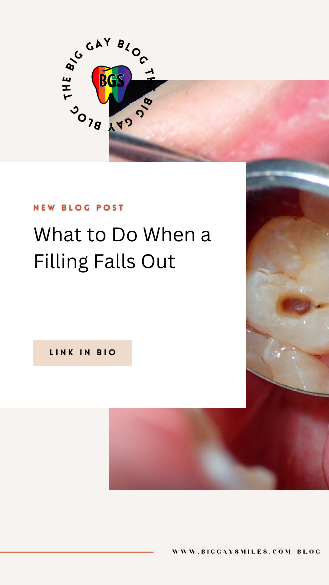 What to Do When a Filling Falls Out