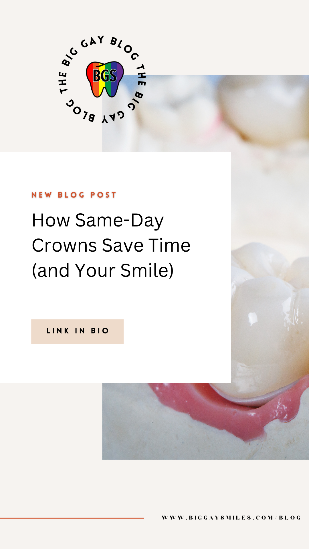 How Same-Day Crowns Save Time (and Your Smile)