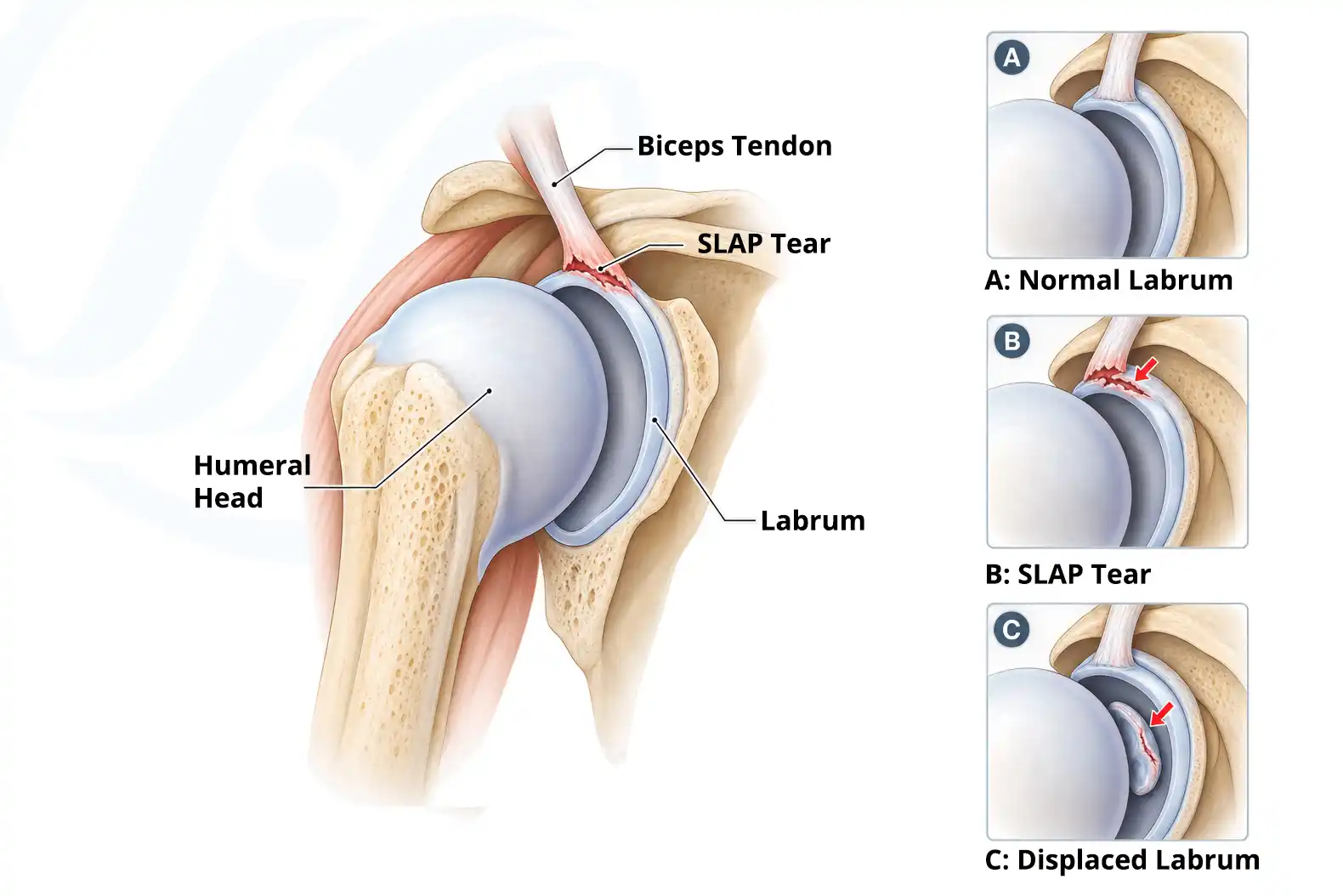Illustration of the right shoulder showing the humeral head, biceps tendon, labrum and a SLAP tear at the top of the labrum, with three smaller panels comparing a normal labrum, a SLAP tear, and a torn labrum displaced between the ball and the socket.