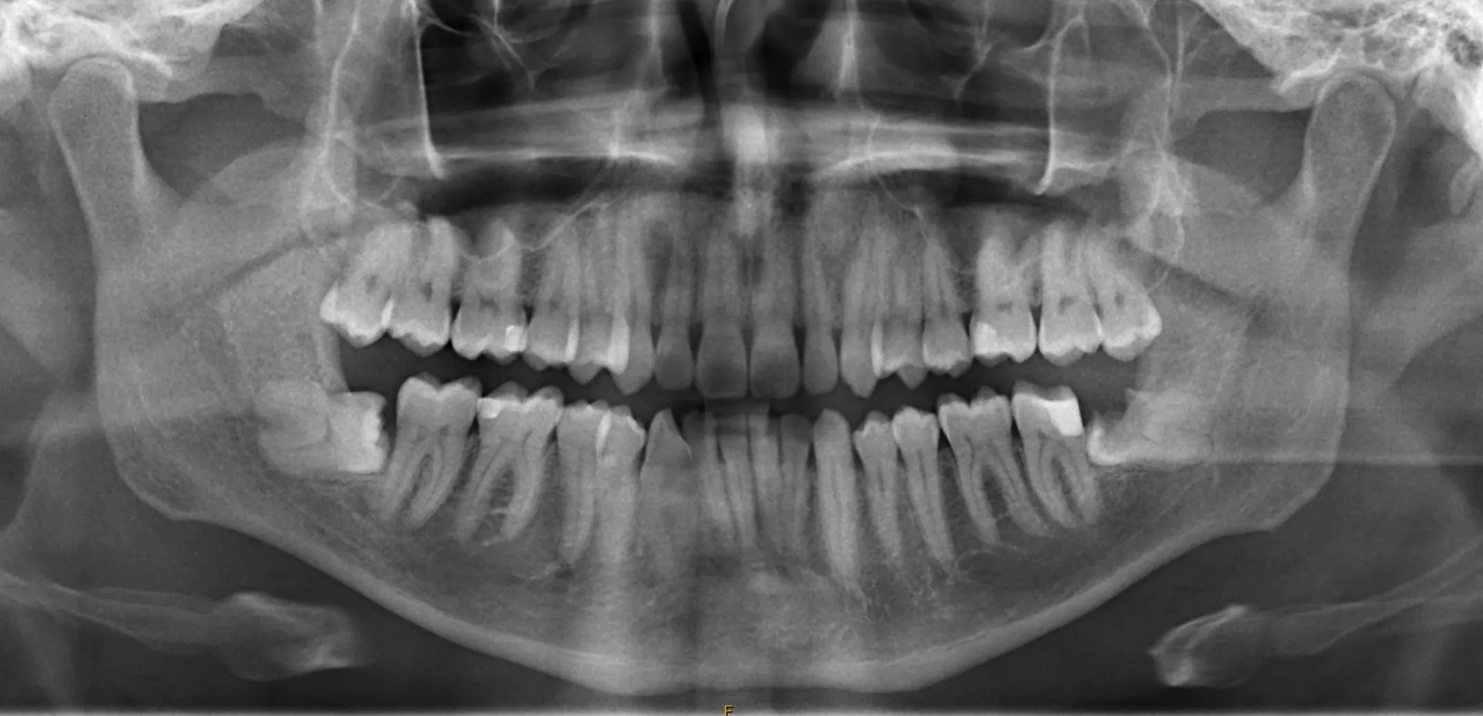 OPG X-ray of patient requiring wisdom teeth removal