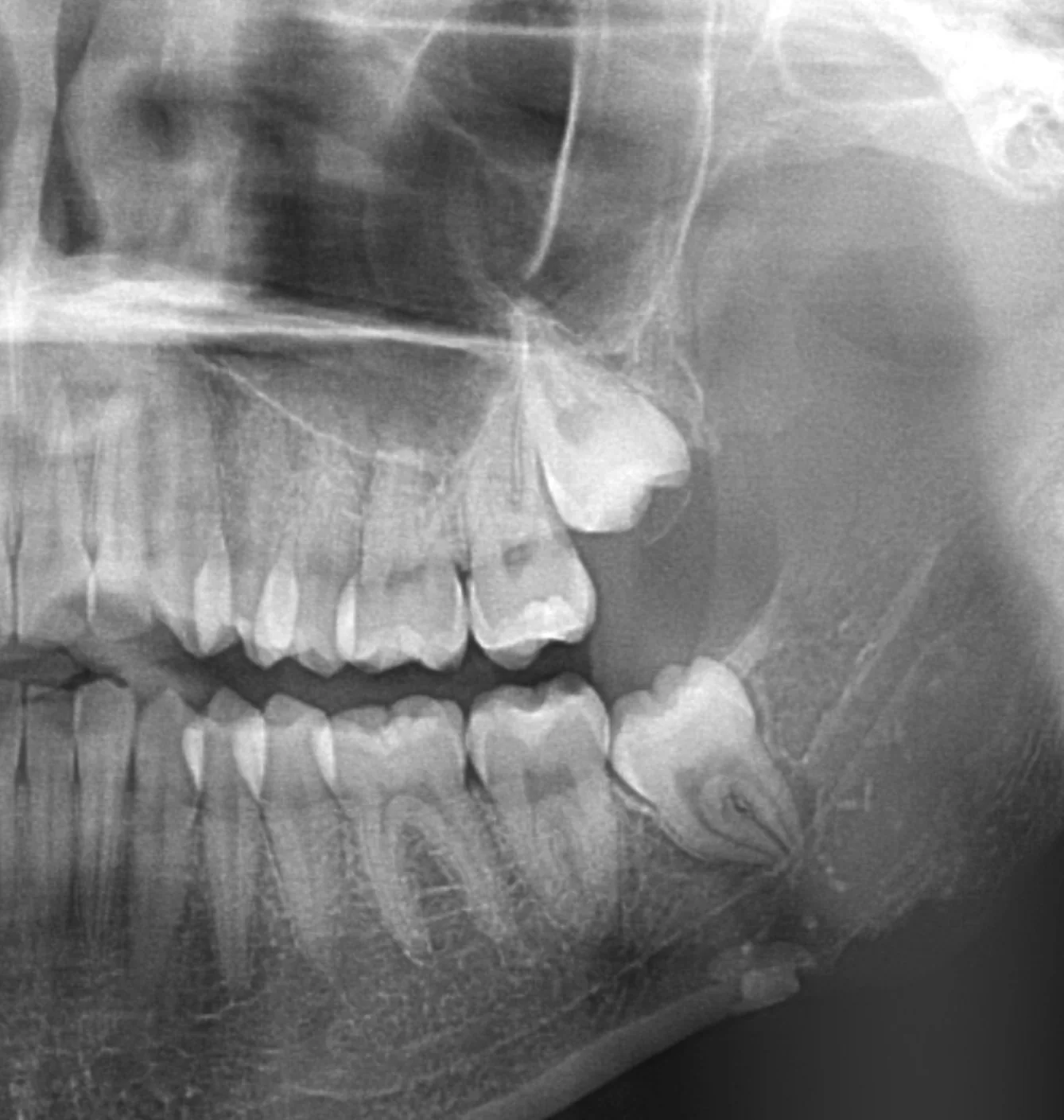 Wisdom Teeth Removal