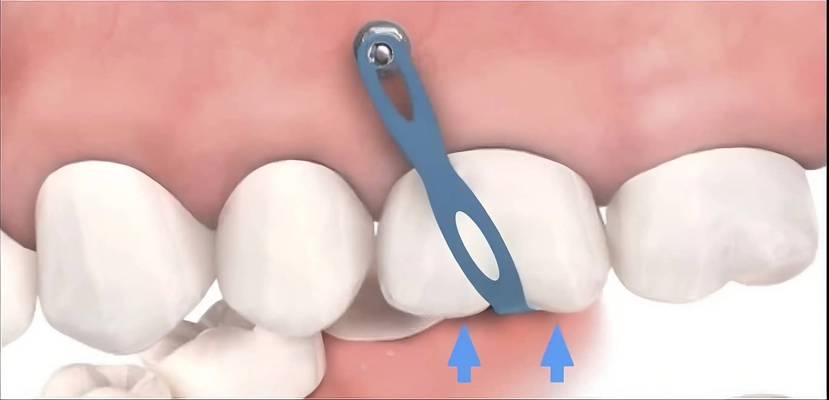 Bone Anchorage Devices