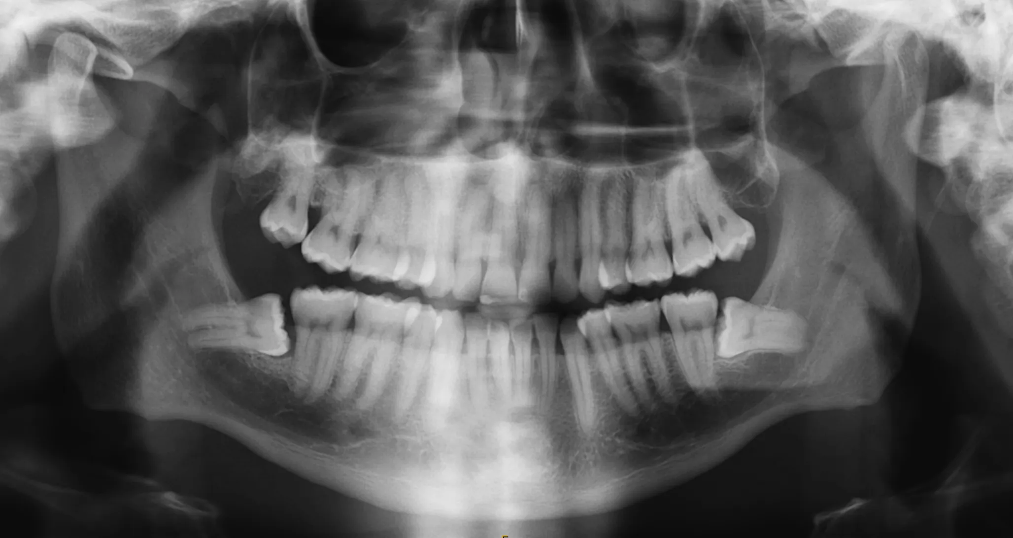 Dento-alveolar Surgery