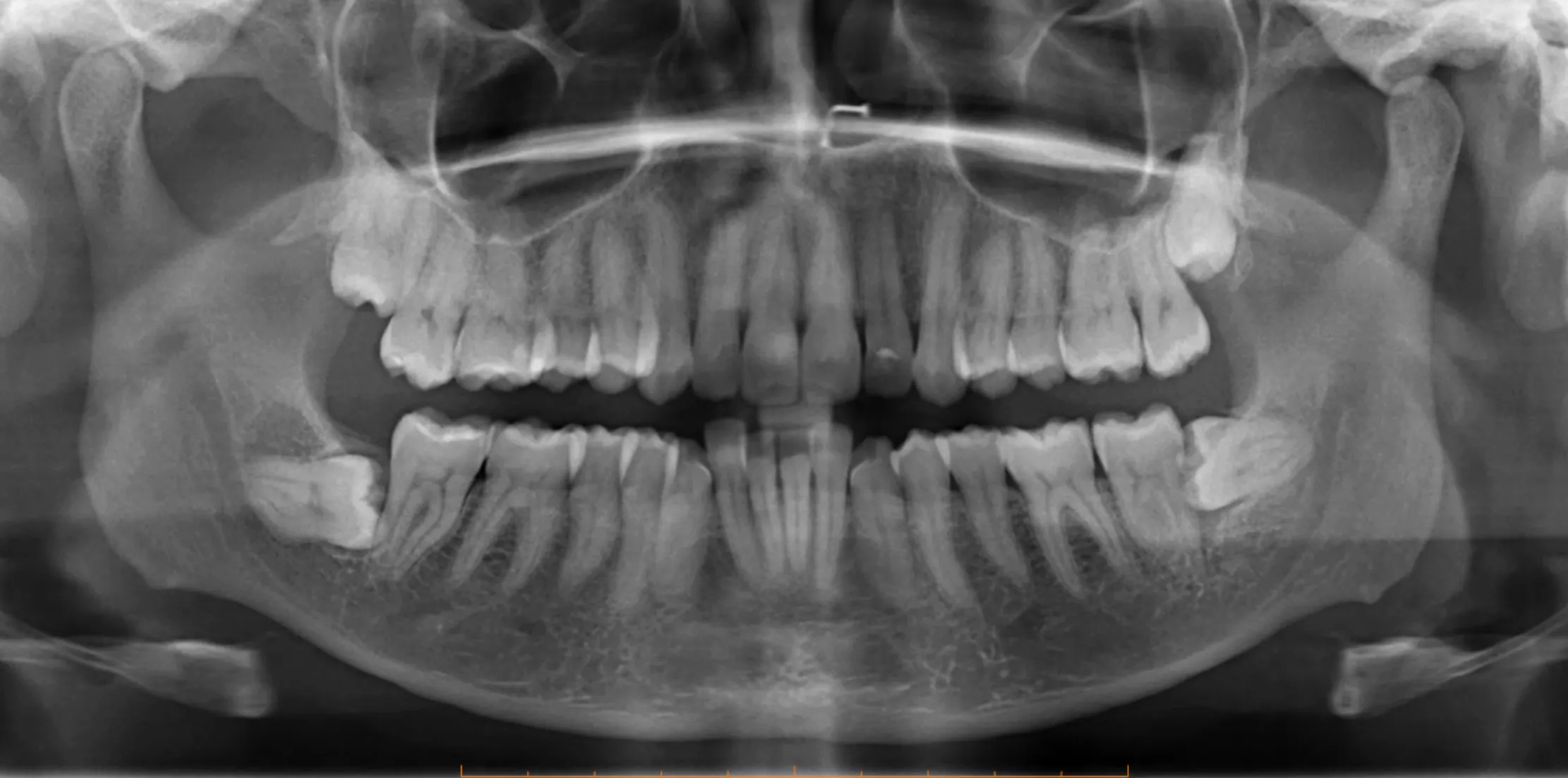 OPG X-ray of impacted wisdom teeth of a Geraldton patient