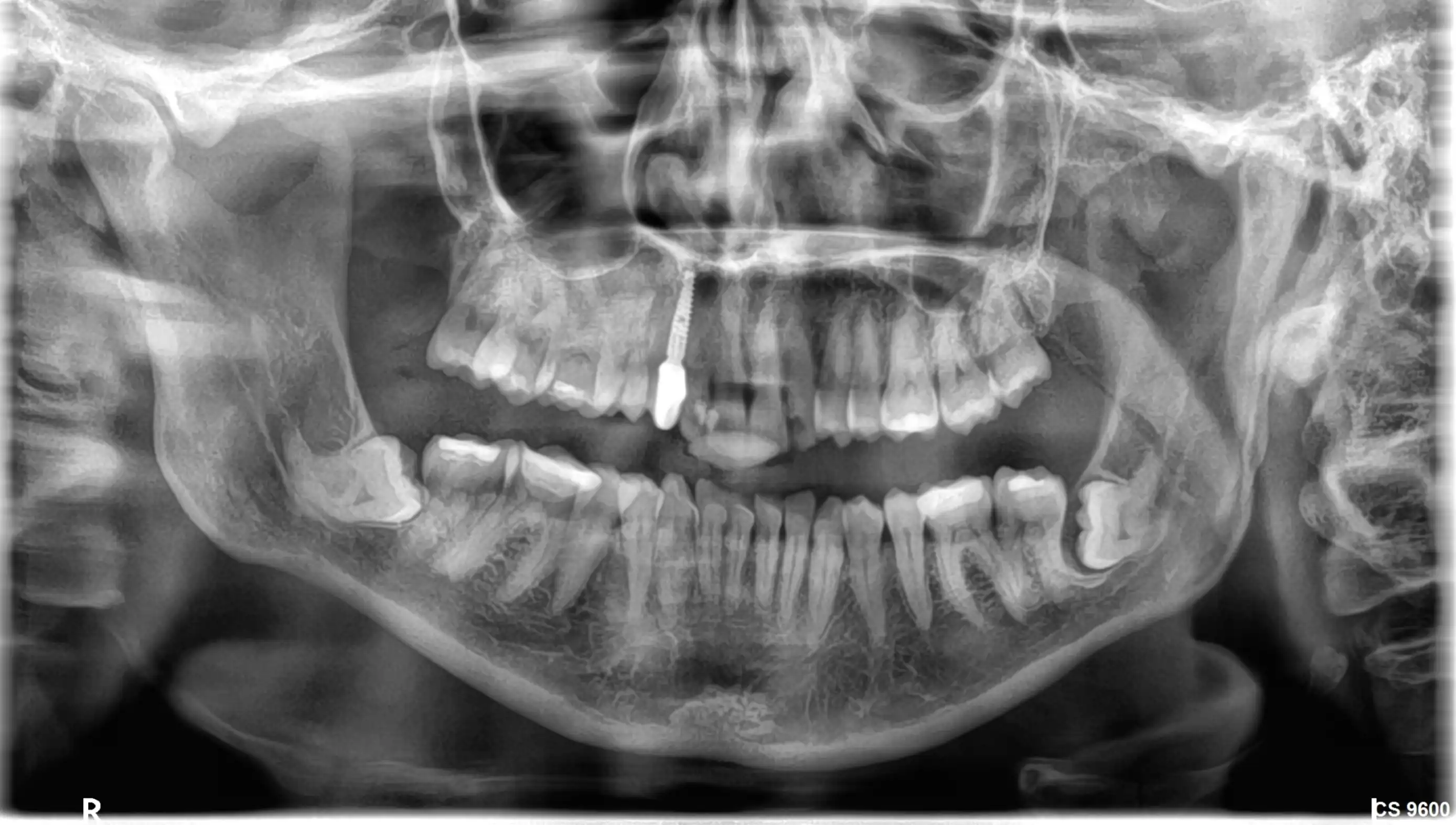 OPG X-ray demonstrating impacted lower wisdom teeth (38 and 48) with root systems in close proximity to the inferior alveolar nerve canals