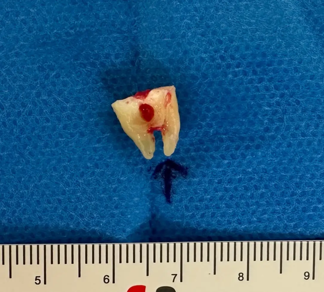 Extracted lower wisdom tooth (38) with mesiobuccal and mesiolingual roots removed safely with nerve preservation