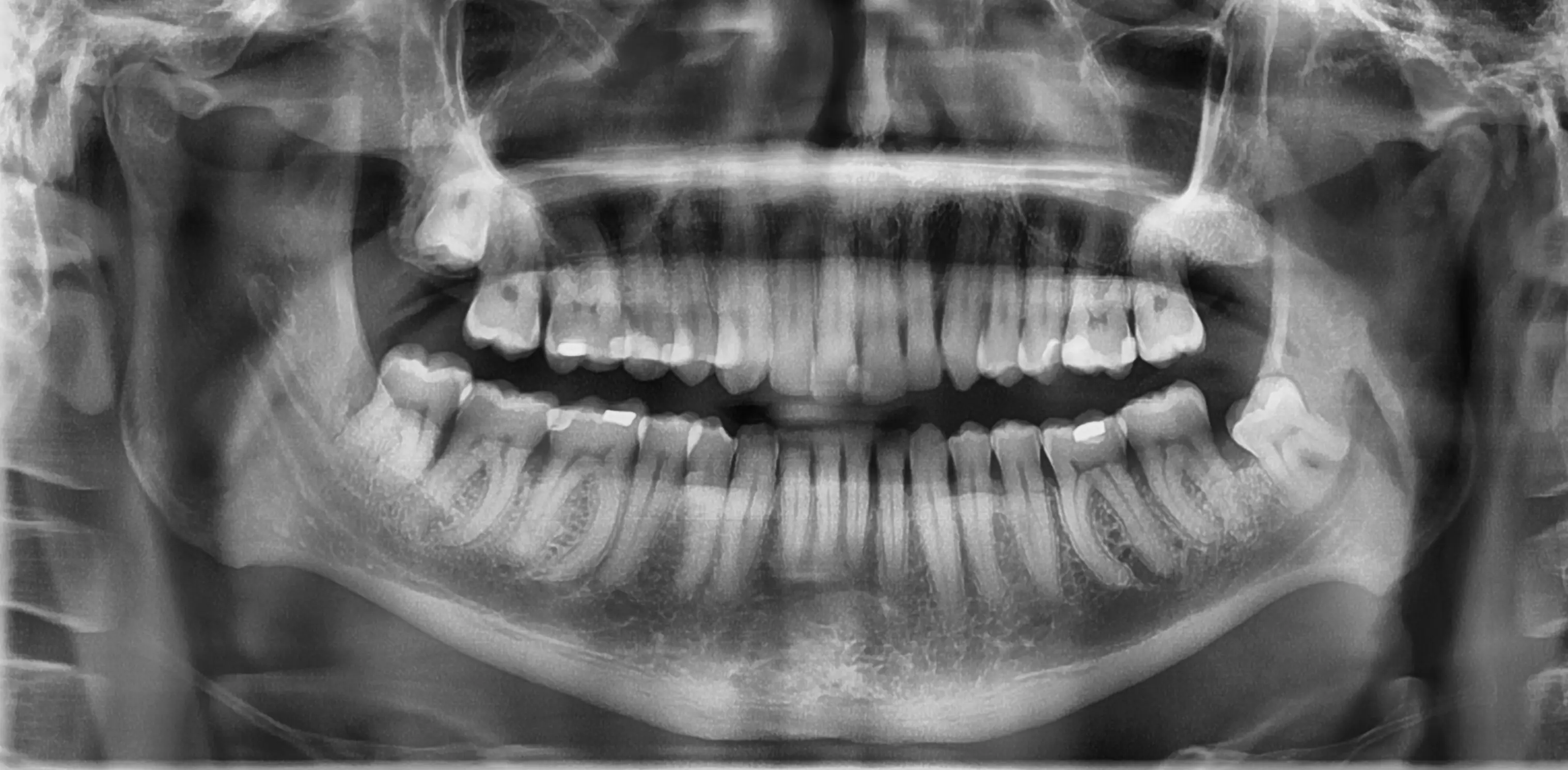 Routine OPG showing impacted wisdom teeth