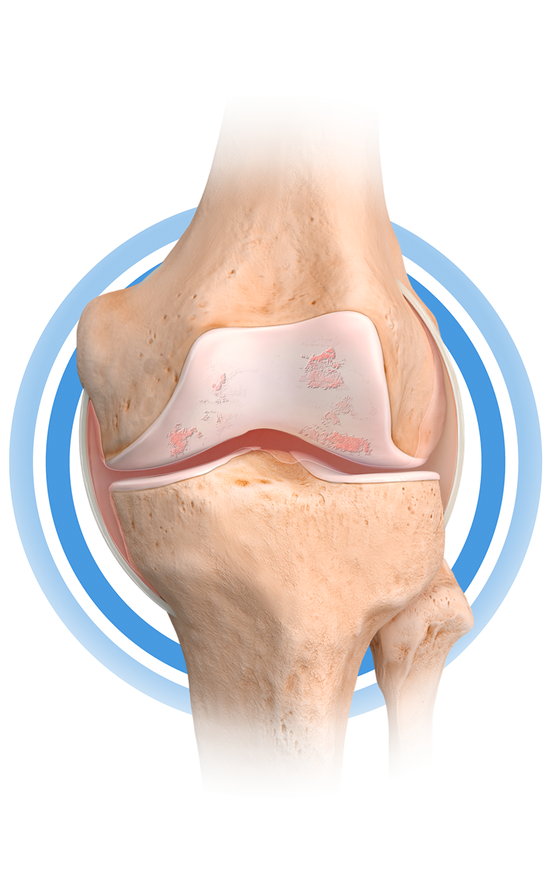 Dessin numérique d'une articulation du genou entourée de vagues bleues.