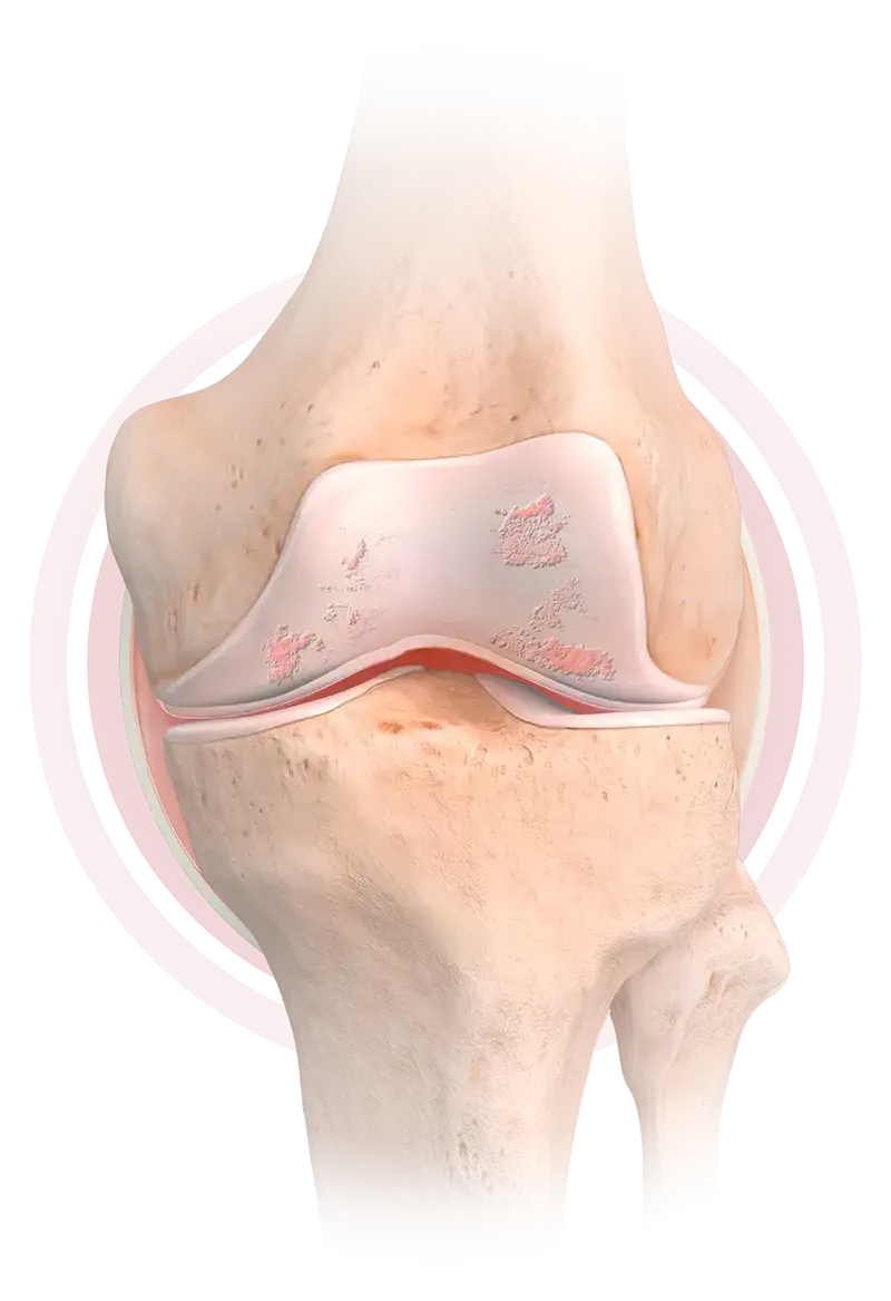 Illustratie van een kniegewricht met zichtbaar slijtage en beschadiging van het gewrichtskraakbeen, ter illustratie van gewrichtsdegeneratie en artritis. De toon is klinisch en educatief.