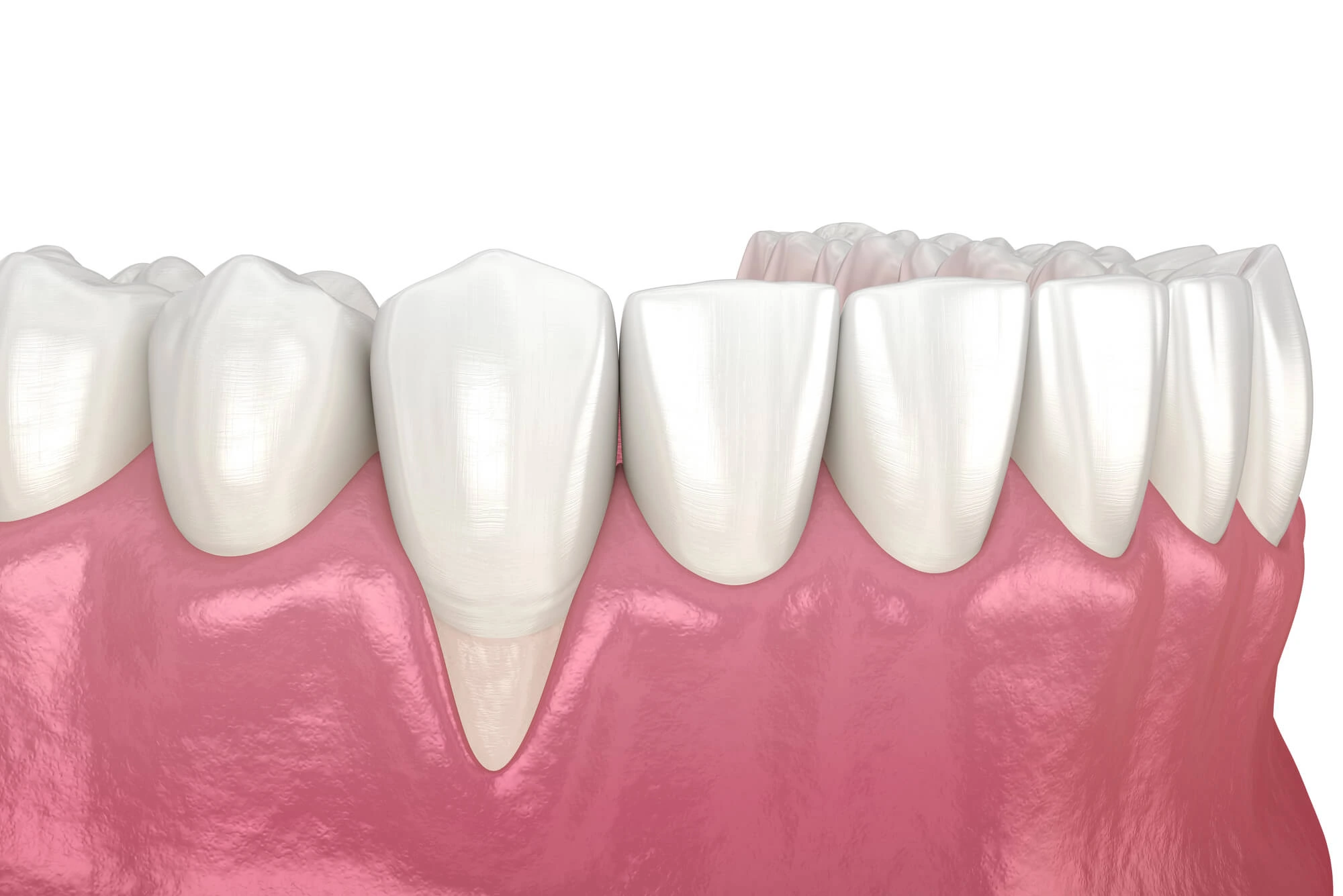 receding gums need Chesapeake comprehensive dentistry
